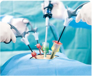 Laparoscopy Surgery
