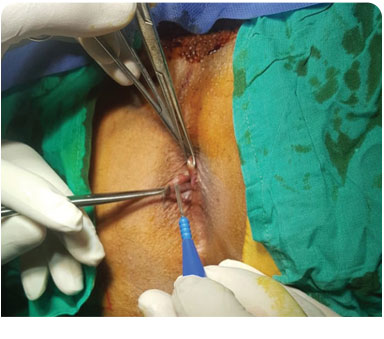 Piles, Fissure & Fistula Surgery