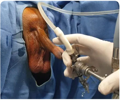 Prostate Surgery