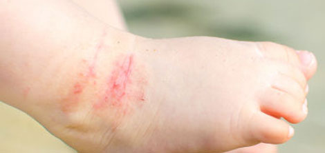 Allergy