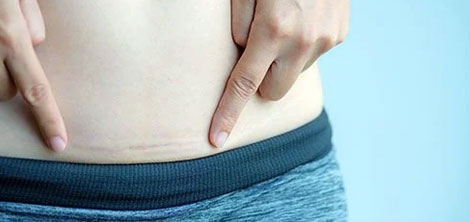 Caesarean Section