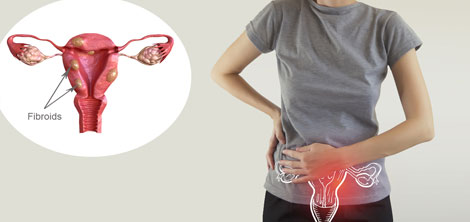 Uterine Fibroids
