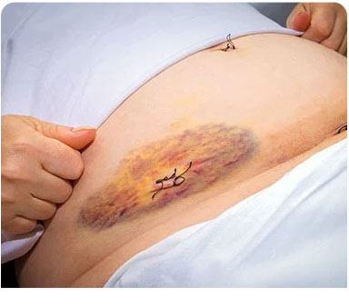 Appendix Removal