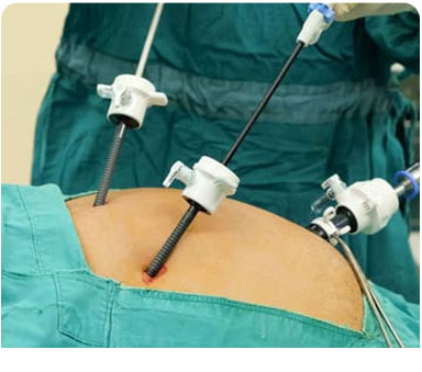 Gallbladder Stone Surgery