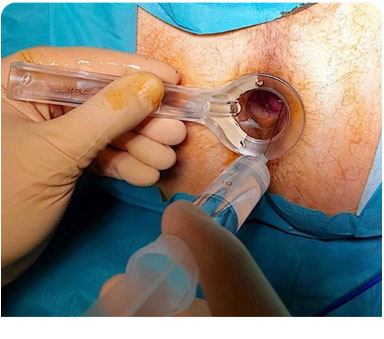 Hemorrhoid Surgery