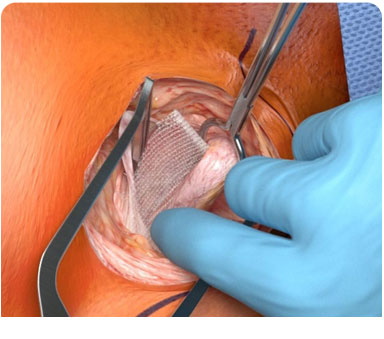 Hernia Surgery