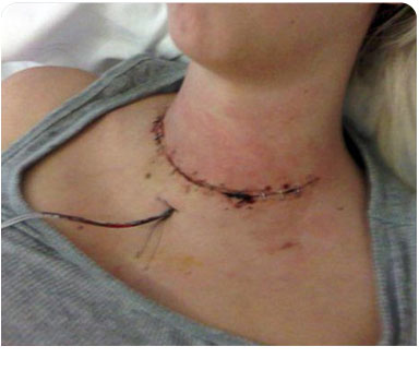 Thyroid Surgery